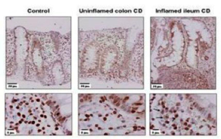 Patologie infiammatorie del tratto gastro intestinale: sviluppo di nuovi biomarcatori e dispositivi medici in una rete pubblico-privato